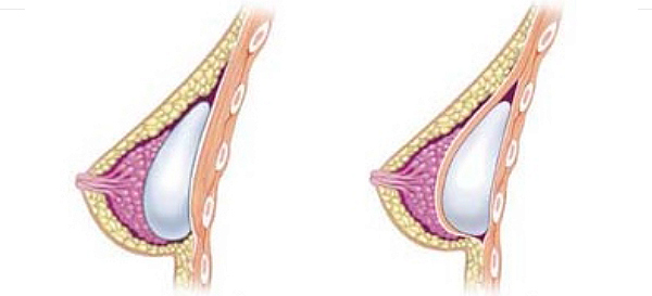 imagen descriptiva de implantes