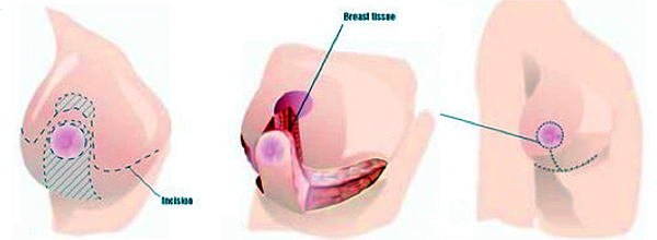 Imagen descriptiva de la cirugía