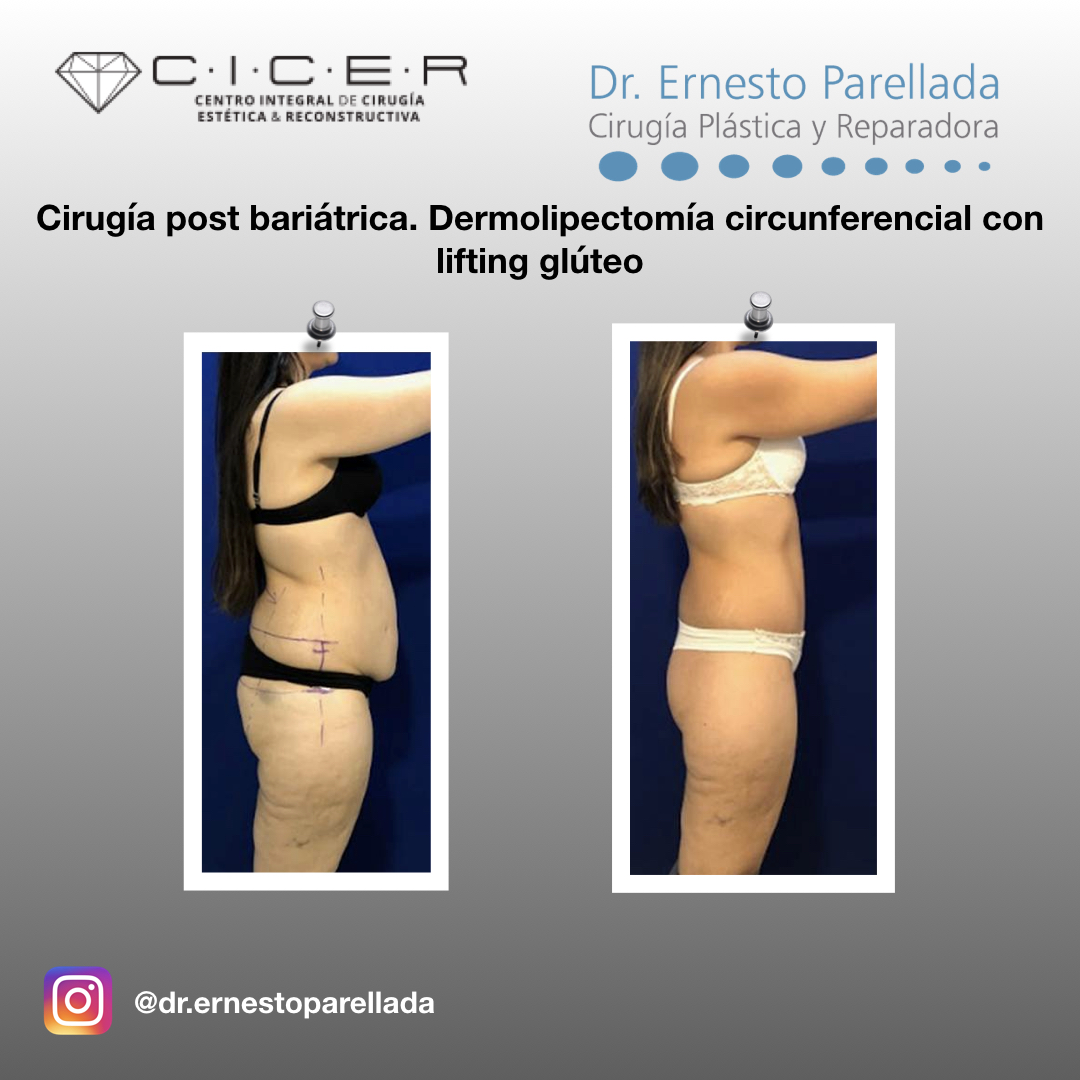 Abdominoplastía (Cirugía Estética del Abdomen) - Kelamis Plastic Surgery